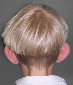 Ear surgery (otoplasty), pre-op