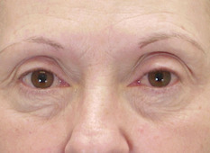 Eyelid lift (blepharoplasty), pre-op