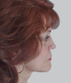 Facelift (rhytidectomy), post-op