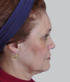 Facelift (rhytidectomy), pre-op