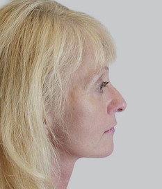 Facelift (rhytidectomy), post-op