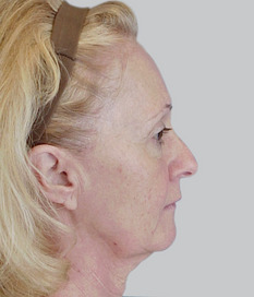 Facelift (rhytidectomy), pre-op