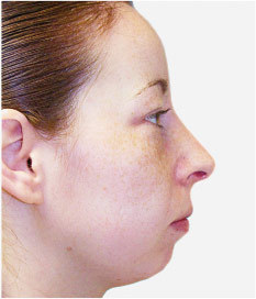 Nose job (rhinoplasty), post-op