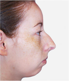 Nose job (rhinoplasty), pre-op