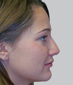 Nose job (rhinoplasty), post-op