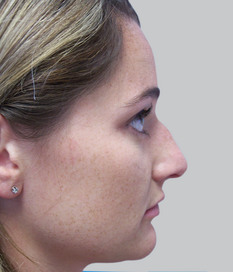 Nose job (rhinoplasty), pre-op
