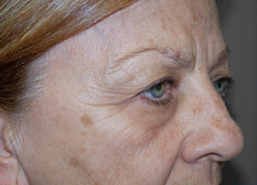 Upper eyelid lift (blepharoplasty), pre-op